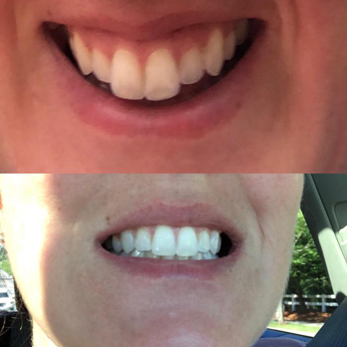 Teeth shaving before and after